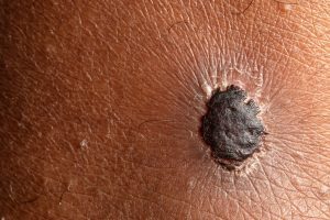melanoma skin cancer