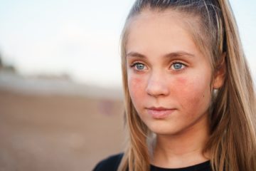 sunburned